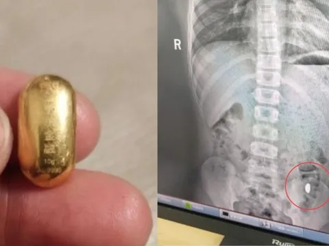 Con trai nuốt miếng vàng của mẹ vào bụng và cái kết